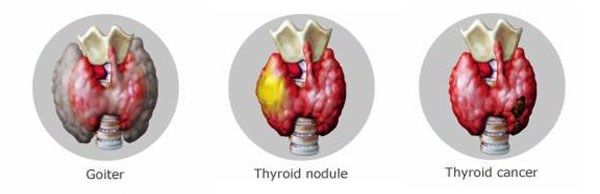 Thyroid Disorder Awareness: Unmasking Your Thyroid
